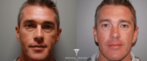Blepharoplasty Price in Turkey