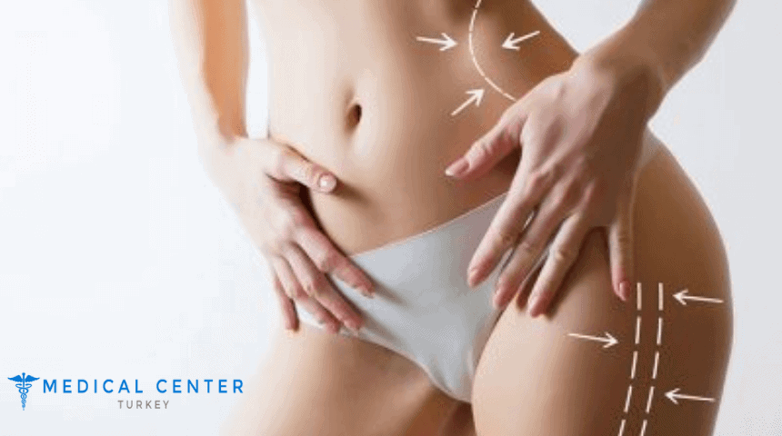 Liposuction in 2025