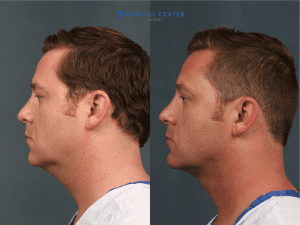 neck-lift-surgery-in-turkey
