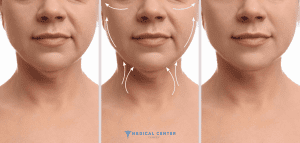 neck-lift-surgery-in-turkey
