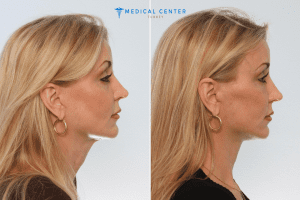 neck-lift-surgery-in-turkey