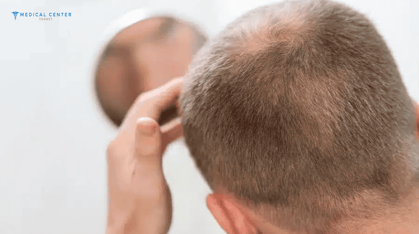 5 Things to Think About Before Getting a Hair Transplant 5 Things to Think About Before Getting a Hair Transplant