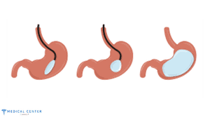 Gastric Balloon in Turkey