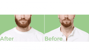 Beard Transplant In Turkey