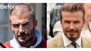 Beard Transplant In Turkey