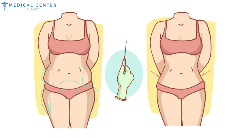 A Complete Guide to Liposuction for Women A Complete Guide to Liposuction for Women