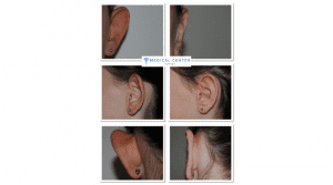Ear Correction Cost in Turkey