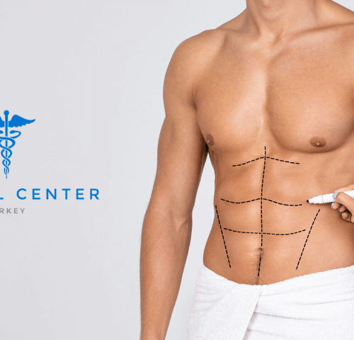 A Complete Guide to Liposuction for Men A Complete Guide to Liposuction for Men