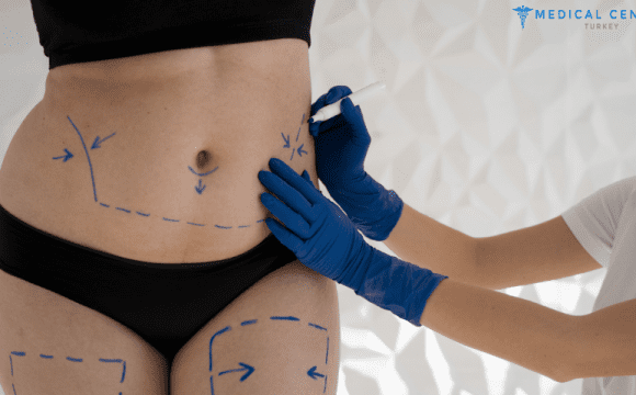 Can Liposuction Help Me Lose Weight?