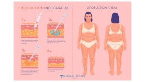 A Complete Guide to Liposuction for Women