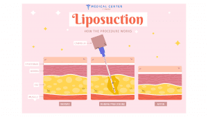 A Complete Guide to Liposuction for Women
