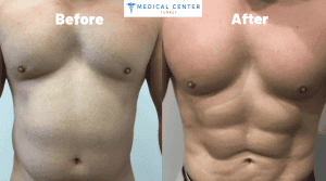 A Complete Guide to Liposuction for Men