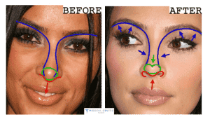 Kim Kardashian's Rhinoplasty Surgery