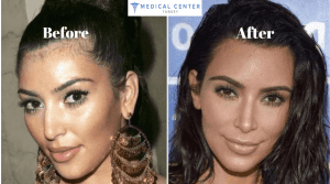 Kim Kardashian's Rhinoplasty Surgery