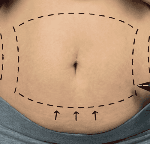 Fat Removal in Turkey