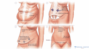 Fat Removal in Turkey