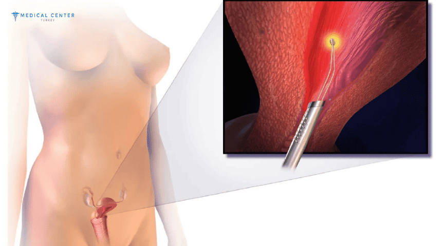 Hysterectomy in Turkey Hysterectomy in Turkey