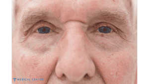 Frequently Asked Questions About Blepharoplasty