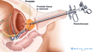 Prostate Cancer Treatment in Turkey