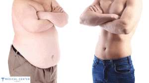 Gastric Band vs Gastric Surgery