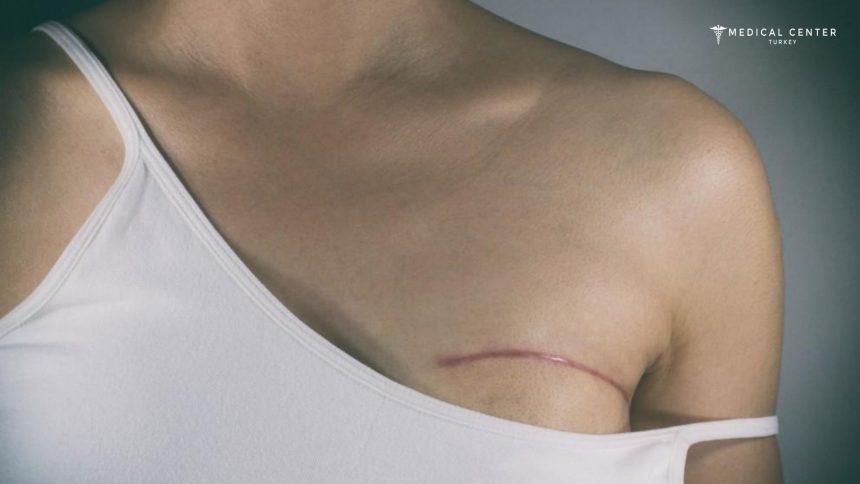 Lumpectomy vs Mastectomy Lumpectomy vs Mastectomy