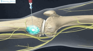 Radiofrequency Ablation in Turkey