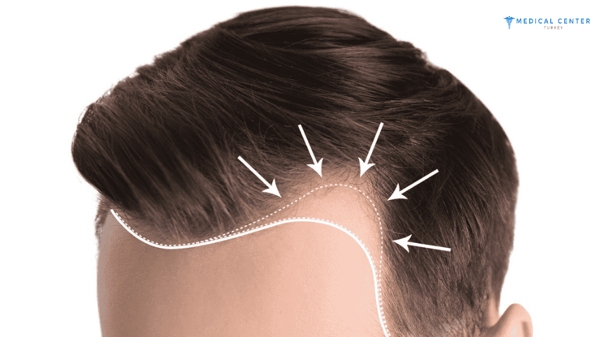 Does Finasteride Regrow Hair? Does Finasteride Regrow Hair?
