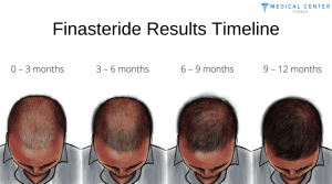 Finasteride vs Minoxidil