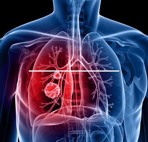 How Much is Lung Cancer Treatment How Much is Lung Cancer Treatment