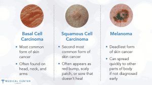 Skin Cancer Treatment in Turkey
