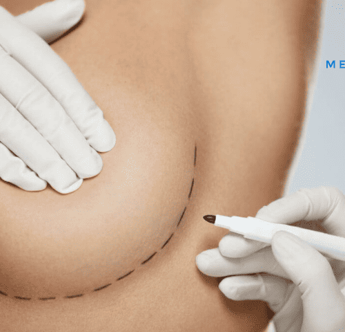 How Often Should Breast Implants Be Replaced How Often Should Breast Implants Be Replaced