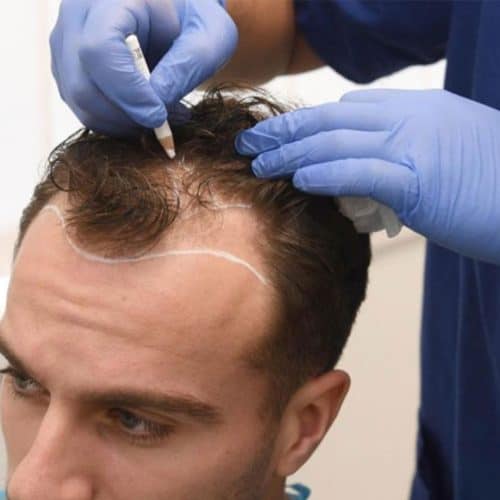 Hair Transplant Before and After Turkey Hair Transplant Before and After Turkey