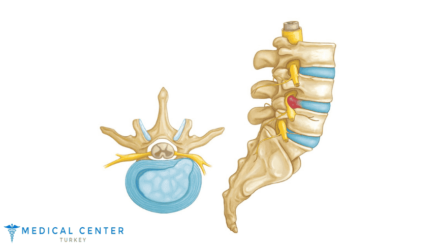 How Much Does Herniated Disc Surgery Cost How Much Does Herniated Disc Surgery Cost