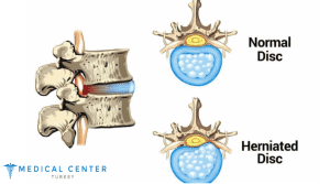 How Much Does Herniated Disc Surgery Cost
