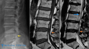 How Much Does Herniated Disc Surgery Cost