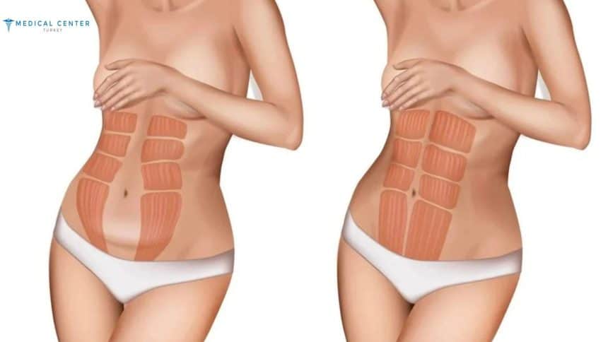 How Much Does Liposuction and A Tummy Tuck Cost How Much Does Liposuction and A Tummy Tuck Cost