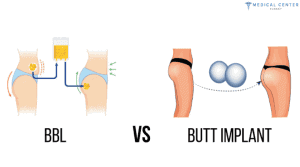 A Guide To Butt Implants In Turkey