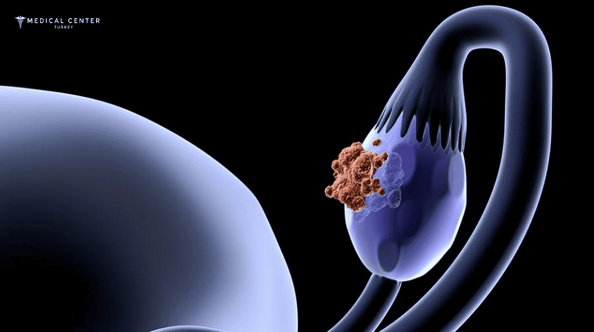 Fallopian Tube Cancer Fallopian Tube Cancer