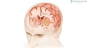 Brain Cancer Treatment in Turkey