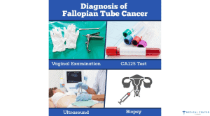 Fallopian Tube Cancer