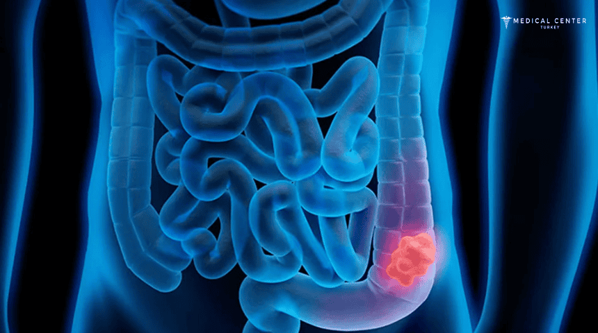 Rectal Cancer Rectal Cancer