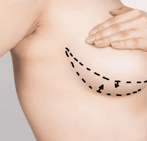 Breast Lift Cost in Turkey