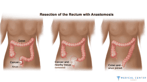Rectal Cancer