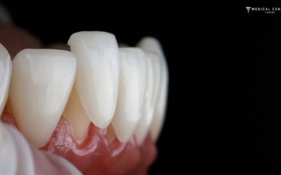 Advantages and Disadvantages of Veneers