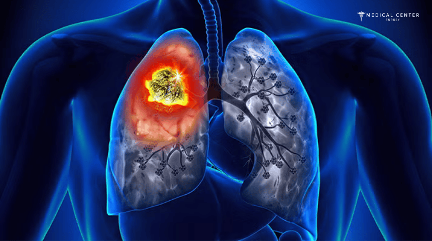 Chemotherapy For Lung Cancer Chemotherapy For Lung Cancer