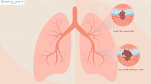 CHEMOTHERAPY FOR LUNG CANCER