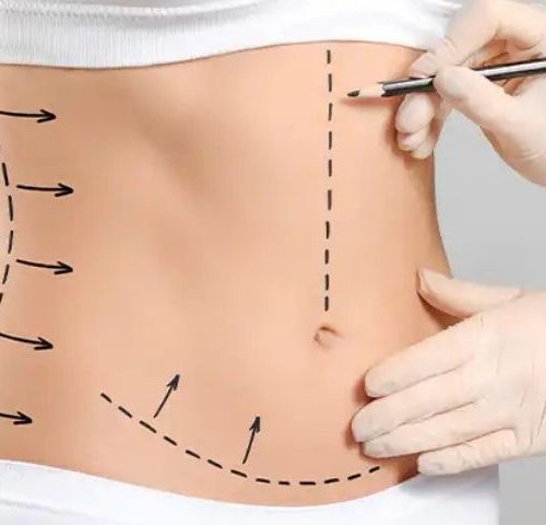 Body Mass Index (BMI) for Liposuction Body Mass Index (BMI) for Liposuction