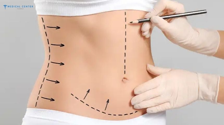 Body Mass Index (BMI) for Liposuction Body Mass Index (BMI) for Liposuction