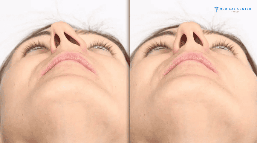 Septoplasty in Turkey