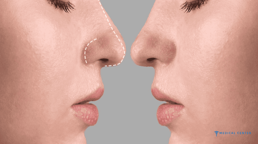 Top 5 Cheapest Countries for Rhinoplasty (Nose Job) in the World Top 5 Cheapest Countries for Rhinoplasty (Nose Job) in the World